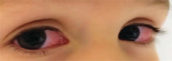 Kawasaki Disease Rheumatology For Primary Care