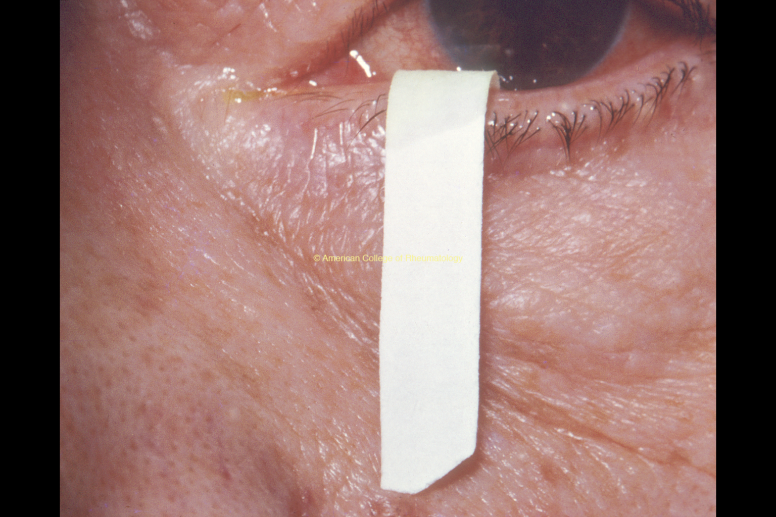 Sjogren s Disease Rheumatology For Primary Care Sjogren s Disease Rheumatology For Primary Care