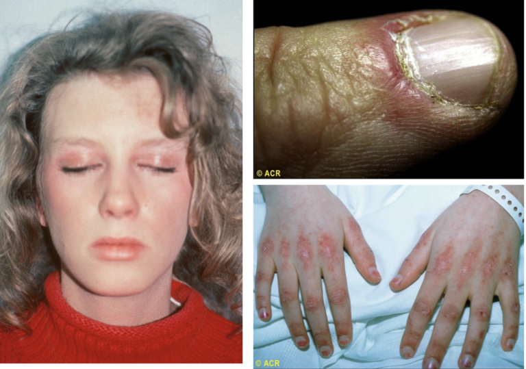Primary Syis Rash Rashes - Rheumatology for Primary Care
